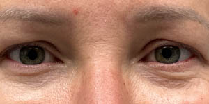 _0004_patient 3 before upper bleph with subbrow filler.PNG