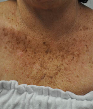 _0004_patient 4 before IPL chest.PNG