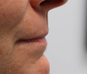_0004_patient 4 before lip filler.PNG