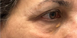 _0004_patient 8 before xanthelasma excision.PNG