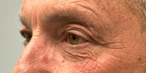 _0005_PATIENT 5 AFTER SUBBROW FILLER.PNG