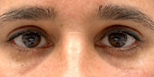 _0005_patient 2 after lower bleph with facial fat grafting (front).PNG