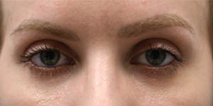 _0005_patient 2 after subbrow filler.PNG