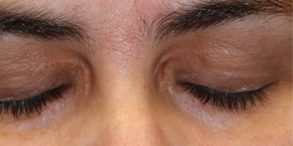 _0005_patient 2 after xanthelasma excision.PNG