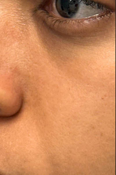 _0005_patient 3 after PRP with microneelding and PRF to undereyes (left side).PNG