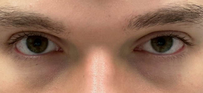 _0005_patient 3 after ptosis repair and subbrow filler.PNG