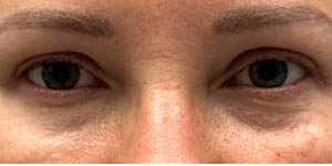 _0005_patient 3 after upper bleph with subbrow filler.PNG