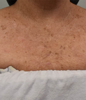 _0005_patient 4 after IPL chest.PNG