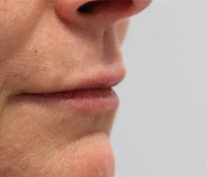 _0005_patient 4 after lip filler.PNG
