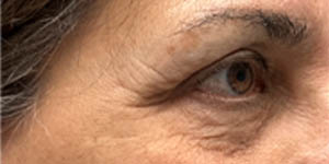 _0005_patient 8 after xanthelasma excision.PNG