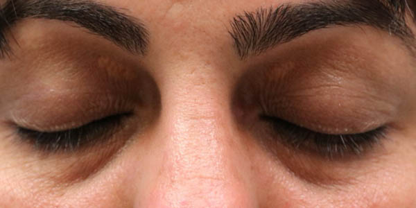 _0006_patient 3 before xanthelasma excision.PNG
