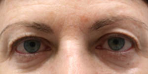 _0006_patient 4 before upper bleph with internal browpexy.PNG