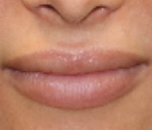 _0006_patient 5 before lip filler.PNG