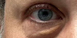 _0006_patient 9 before xanthelasma excision.PNG