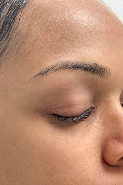 _0007_patient 3 after PRP with microneelding and PRF to undereyes (right side).PNG