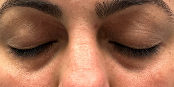 _0007_patient 3 after xanthelasma excision.PNG