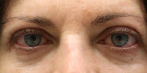 _0007_patient 4 after upper bleph with internal browpexy.PNG