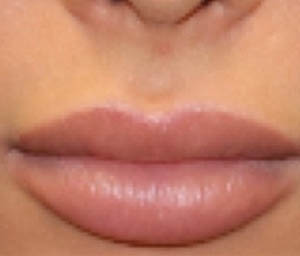 _0007_patient 5 after lip filler.PNG