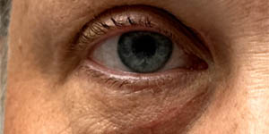 _0007_patient 9 after xanthelasma excision.PNG