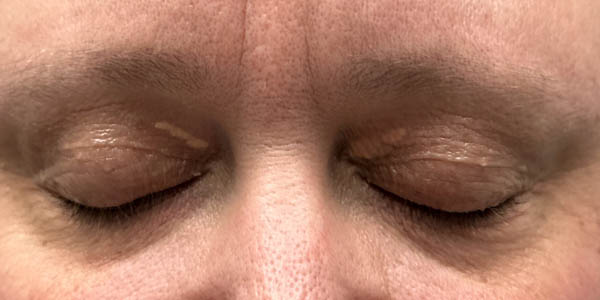 _0008_patient 4 before xanthelasma excision (closed).PNG