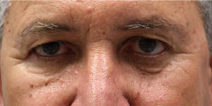 _0008_patient 5 before upper bleph with direct brow lift.PNG