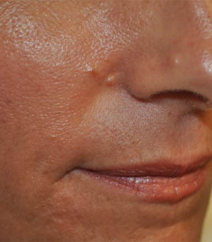 _0008_patient 9 before lesion removal.PNG