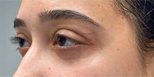 _0009_patient 3 after lower bleph with facial fat grafting (side).PNG