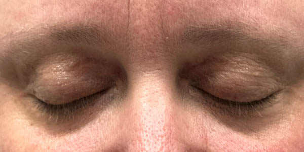 _0009_patient 4 after xanthelasma excision (closed).PNG
