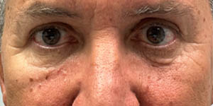 _0009_patient 5 after upper bleph with direct brow lift.PNG