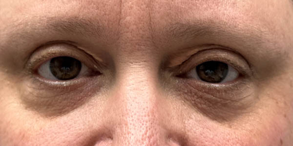 _0010_patient 4 before xanthelasma excision (open).PNG