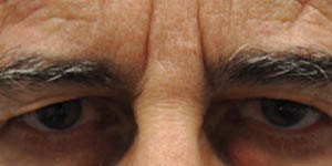 _0010_patient 6 before upper bleph.PNG