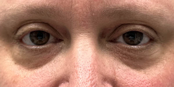_0011_patient 4 after xanthelasma excision (open).PNG