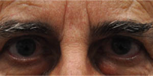 _0011_patient 6 after upper bleph (1).PNG