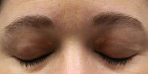 _0012_patient 12 before xanthelasma excision.PNG