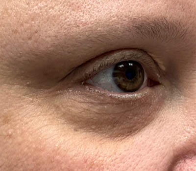 _0012_patient 4 before xanthelasma excision (side).PNG