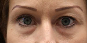 _0012_patient 5 before lower bleph with mid-face volume.PNG
