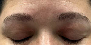 _0013_patient 12 after xanthelasma excision.PNG
