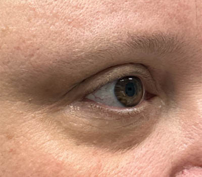 _0013_patient 4 after xanthelasma excision (side).PNG