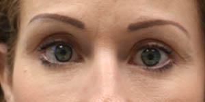 _0013_patient 5 after lower bleph with mid-face volume.PNG