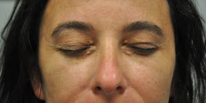 _0014_patient 13 before xanthelasma excision(eyes closed).JPG