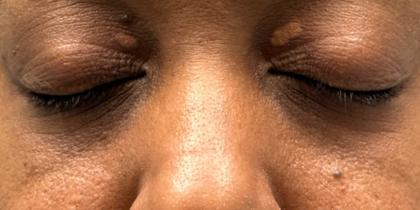 _0014_patient 5 before xanthelasma excision.PNG