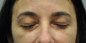 _0015_patient 13 after xanthelasma excision (eyes closed).JPG