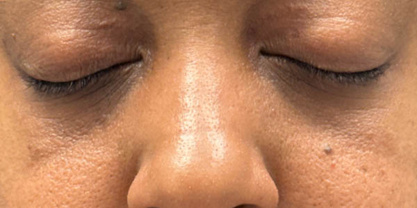 _0015_patient 5 after xanthelasma excision.PNG