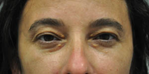 _0016_patient 13 before xanthelasma exision.JPG