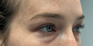 _0016_patient 7 before lower bleph facial fat grafting (right side).PNG