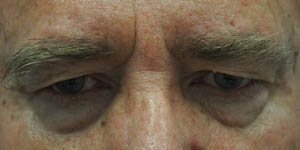 _0016_patient 7 before upper bleph (side) (2).PNG