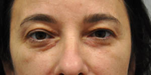 _0017_patient 13 after xanthelasma exision.JPG