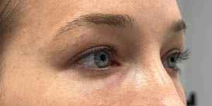 _0017_patient 7 after lower bleph facial fat grafting (right side).PNG