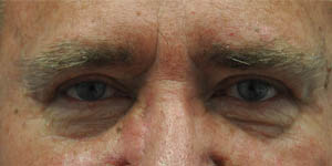 _0017_patient 8 after upper bleph.PNG