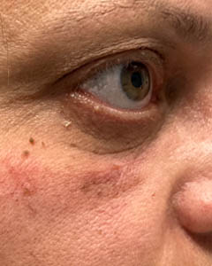 1_0001_patient 10 after xanthelasma excision.PNG